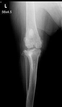 Pre-surgery knee