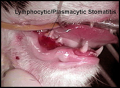 Plasma Cell Stomatitis